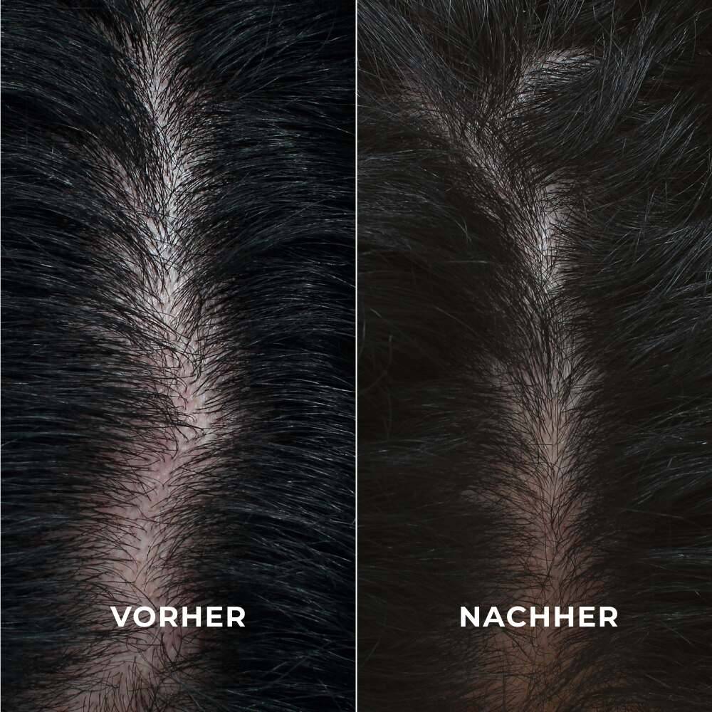Intensive Anti-Haarausfall Verdichtungskur